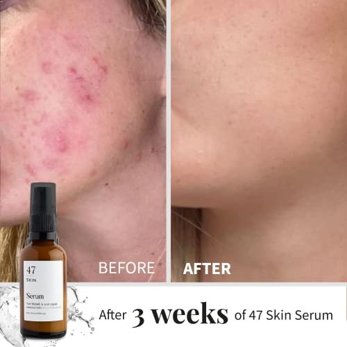 47 Skin Hydrating Face Serum for Clearing Acne & Scars, Anti-Blemish & Scar Repair Serum Skincare Treatment with Silver Chitoderm - Smooth Skin Moisturiser Facecare Serum for All Skin Types (1.01 oz) - Image 4